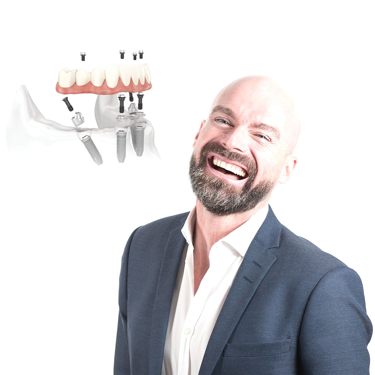 Gli impianti dentali All On Four: una soluzione fissa per i denti mancanti